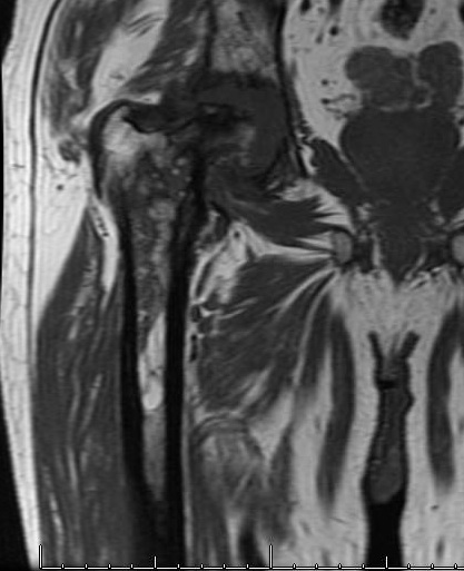 Proximal Femur Osteomyelitis MRI